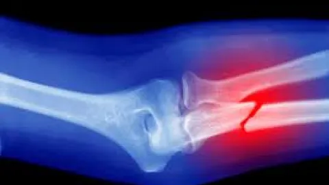 Devrim niteliğinde buluş: Kemik kırıklarını dakikalar içinde onaran yapıştırıcı